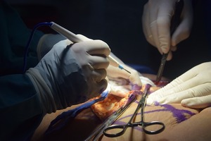 Unveiling the Secret: Why Cosmetic Surgery is Taking over the World