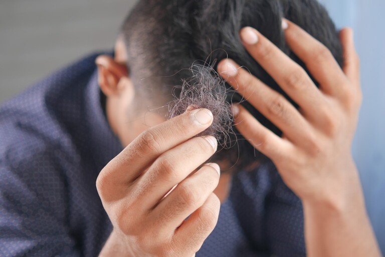 Hair Loss: What’s Causing It and What Needs to Be Done