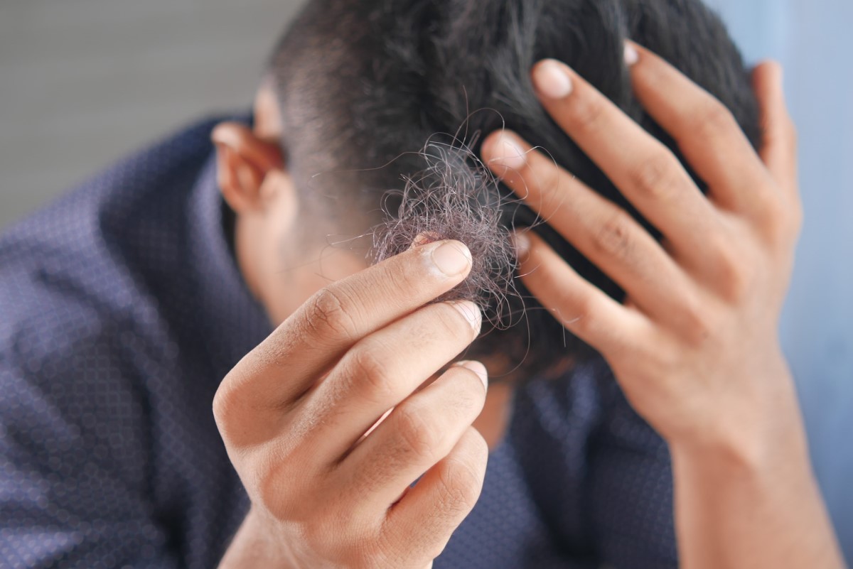 Hair Loss: What’s Causing It and What Needs to Be Done